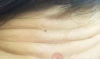 去除鱼尾纹价格 去除鱼尾纹价格